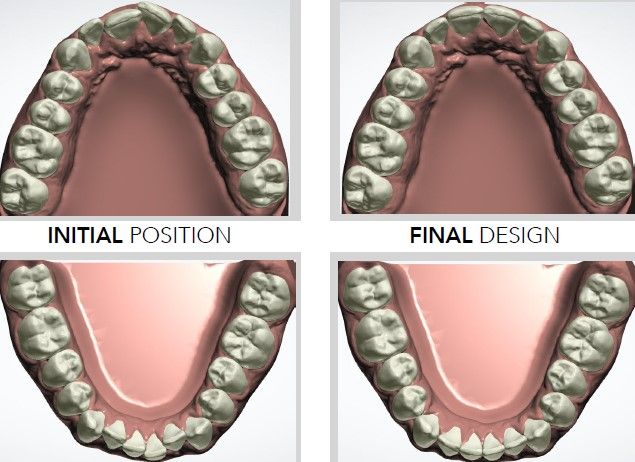 Clear Aligner treatment planning - Active Aligners