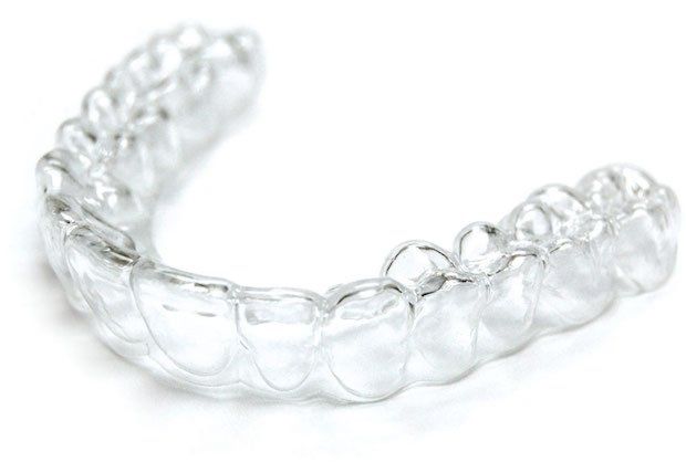 What are Active Aligners and clear aligners?