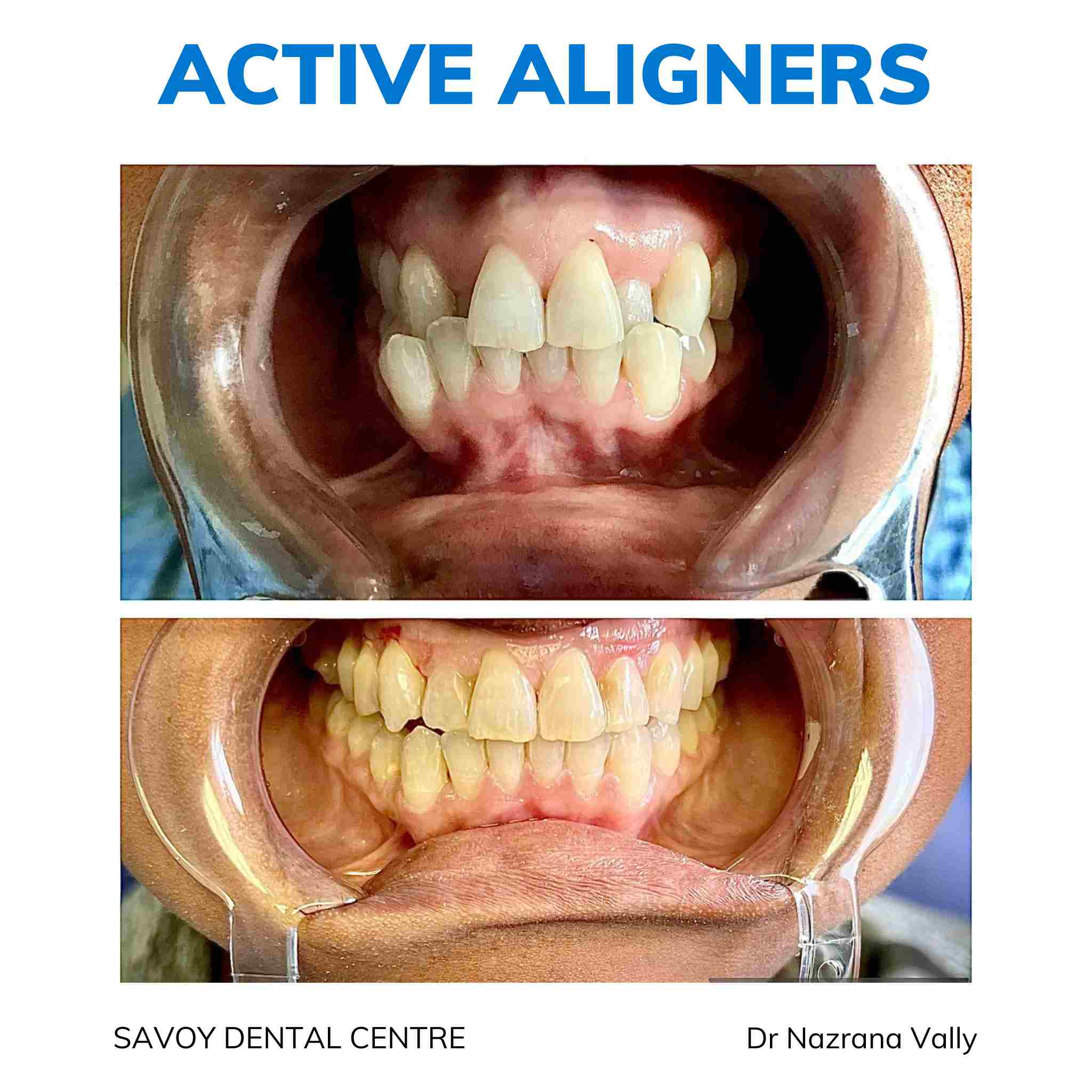 Active Aligners before and after result