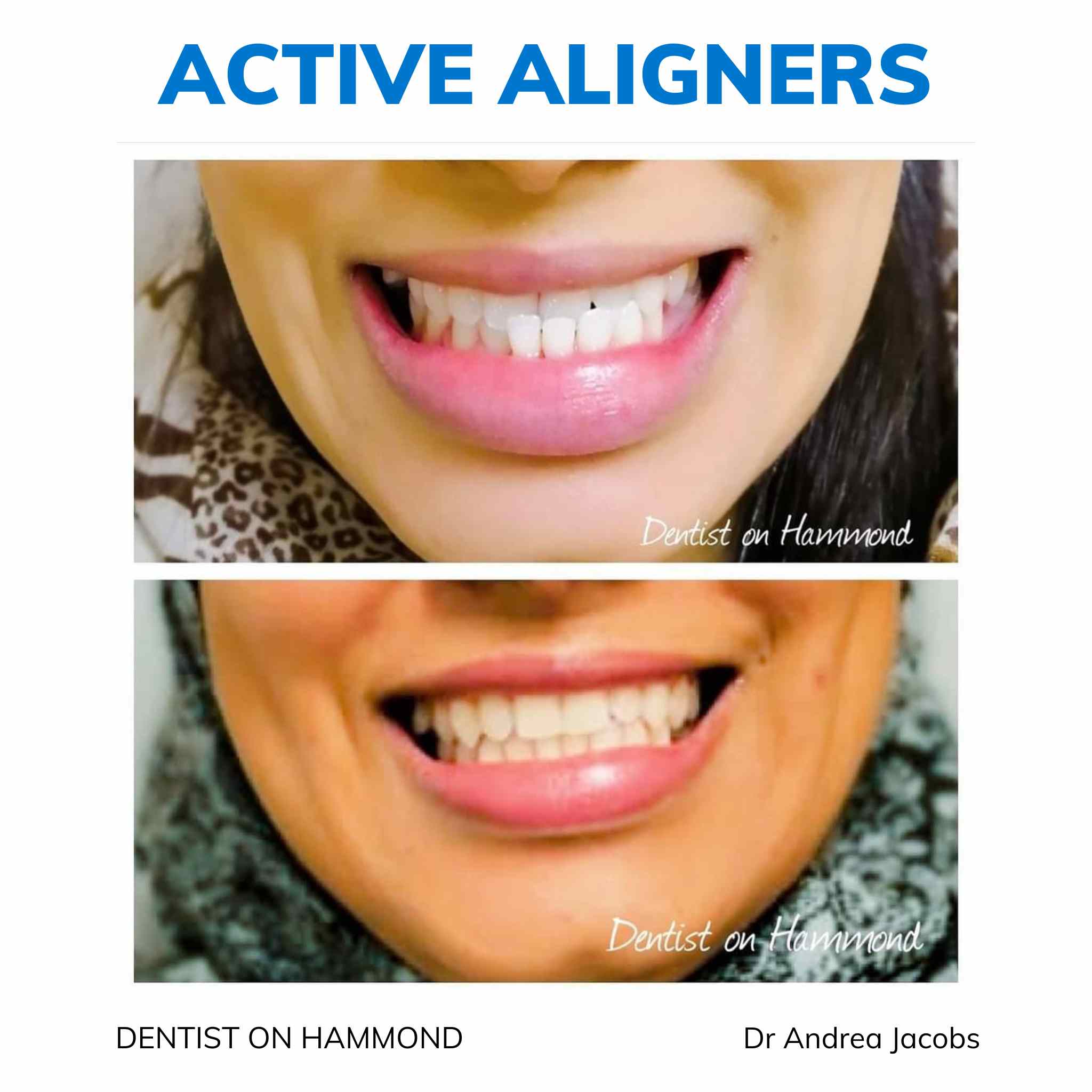 Active Aligners before and after result